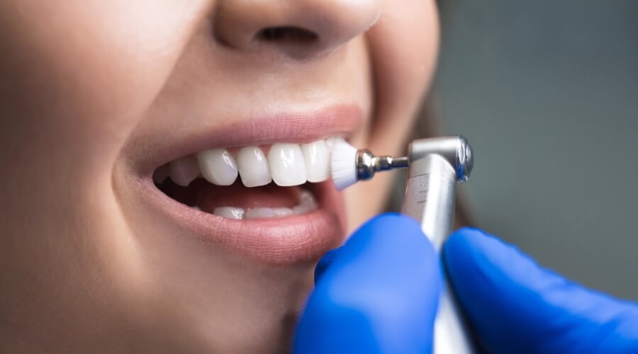 تنظيف وتلميع الأسنان باستخدام الاملاح المعدنية